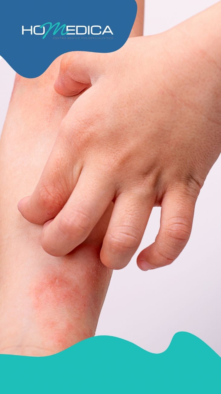 Dermatite atopica: cos’è, come riconoscerla e quando rivolgersi al dermatologo